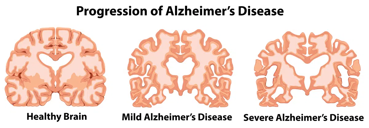 Alzheimer