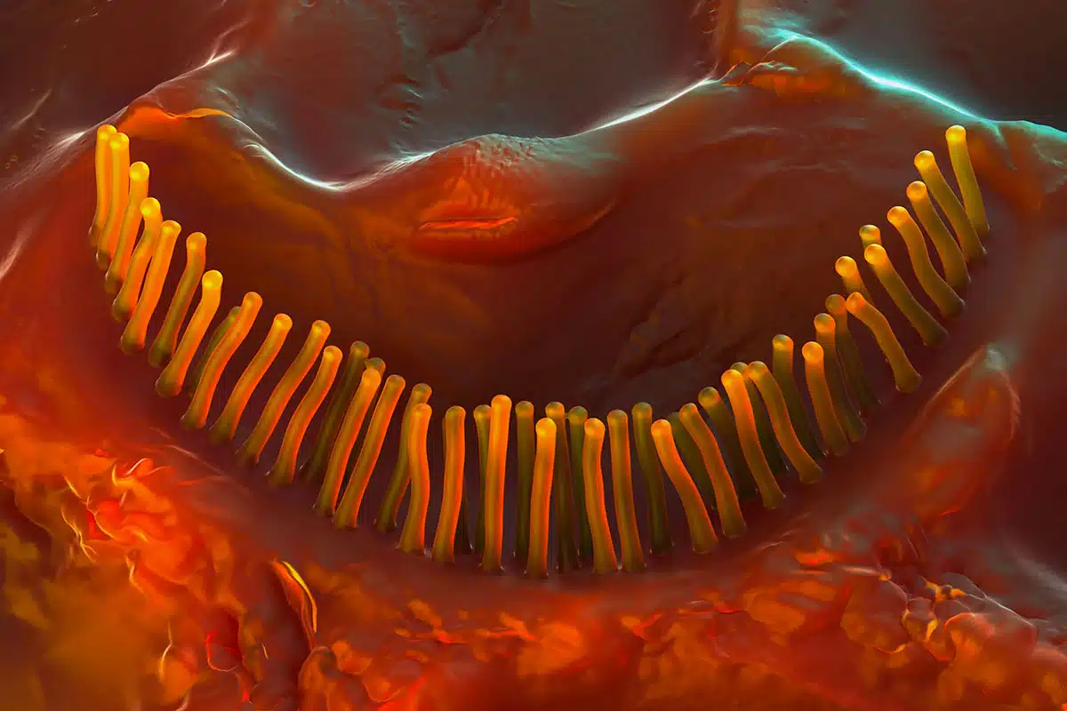 Ipoacusia Neurosensoriale
