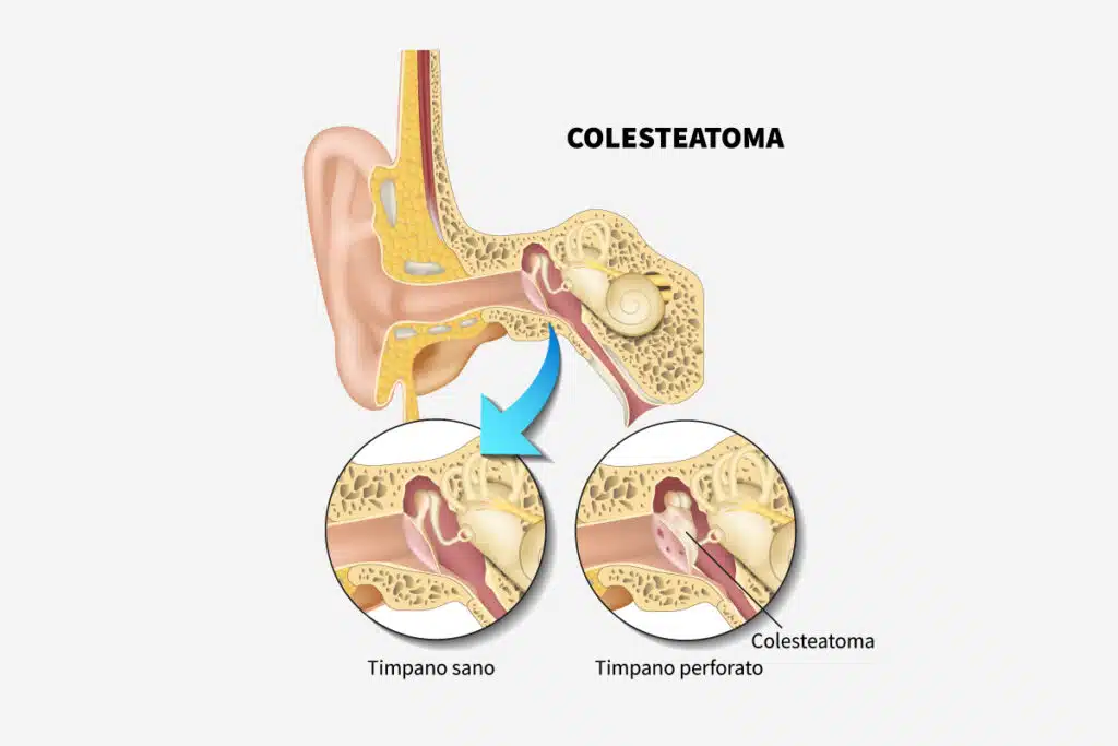 Colesteatoma