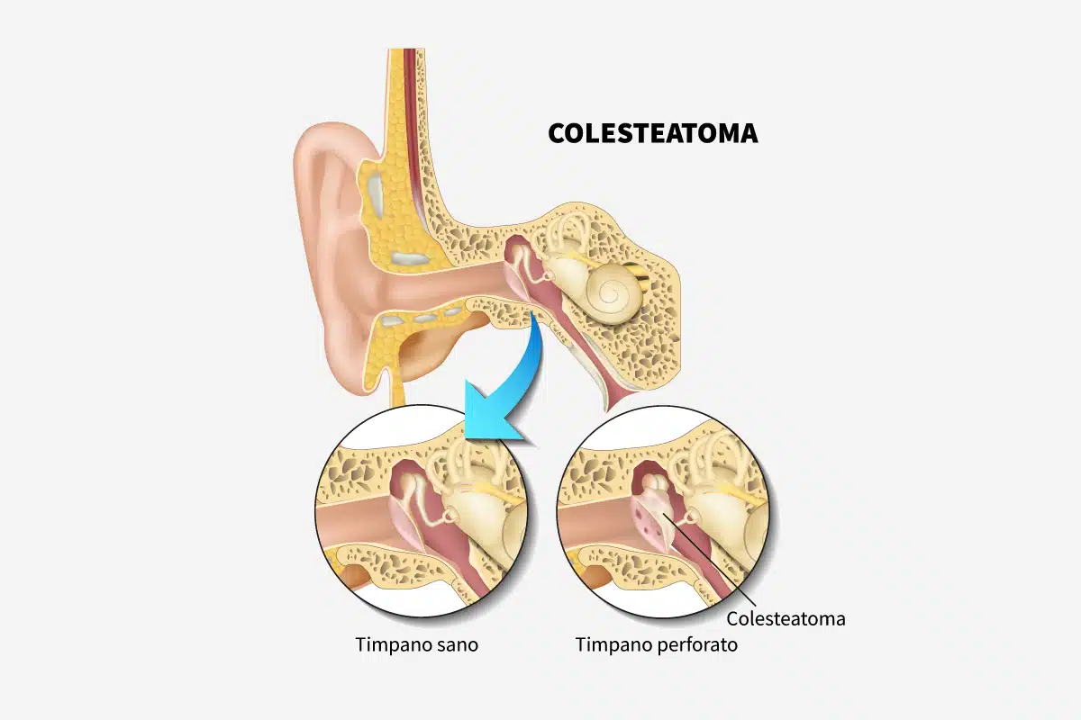 Colesteatoma