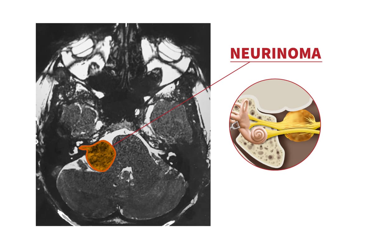neurinoma